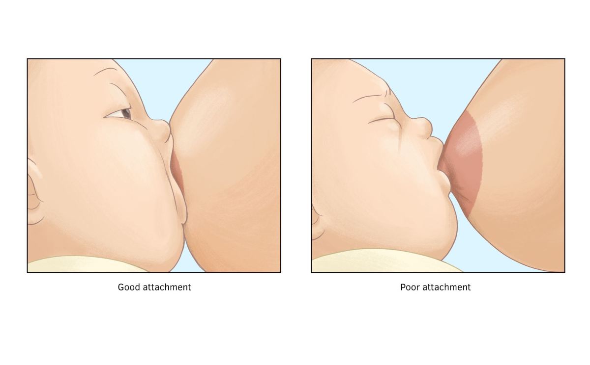 為什麼餵奶時乳頭會痛？